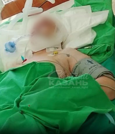 В Казани женщина оказалась на ИВЛ после нападения стаффордширского терьера